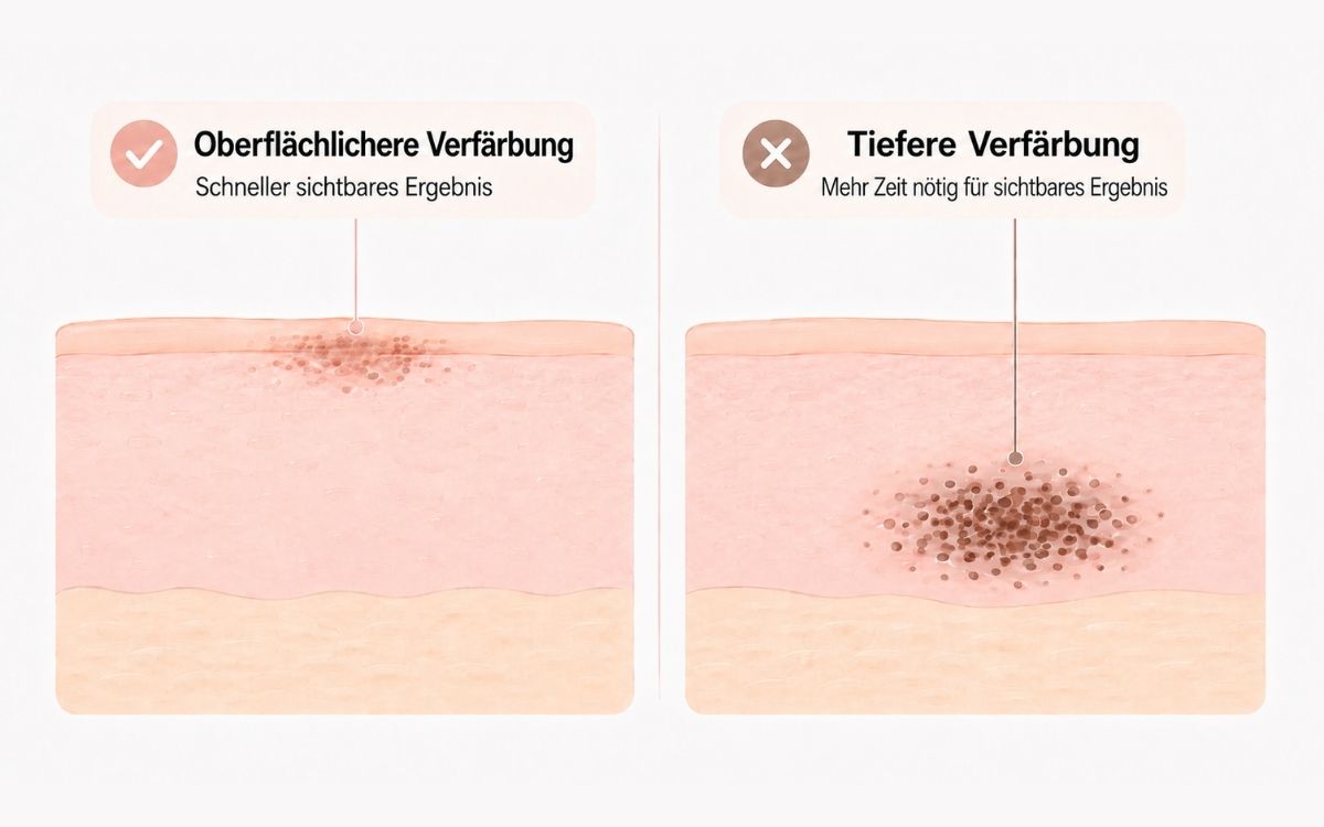 Unterschied zwischen oberflächlicher und tiefer Verfärbung nach einem eingewachsenen Haar Unterschied zwischen oberflächlicher und tiefer Verfärbung nach einem eingewachsenen Haar